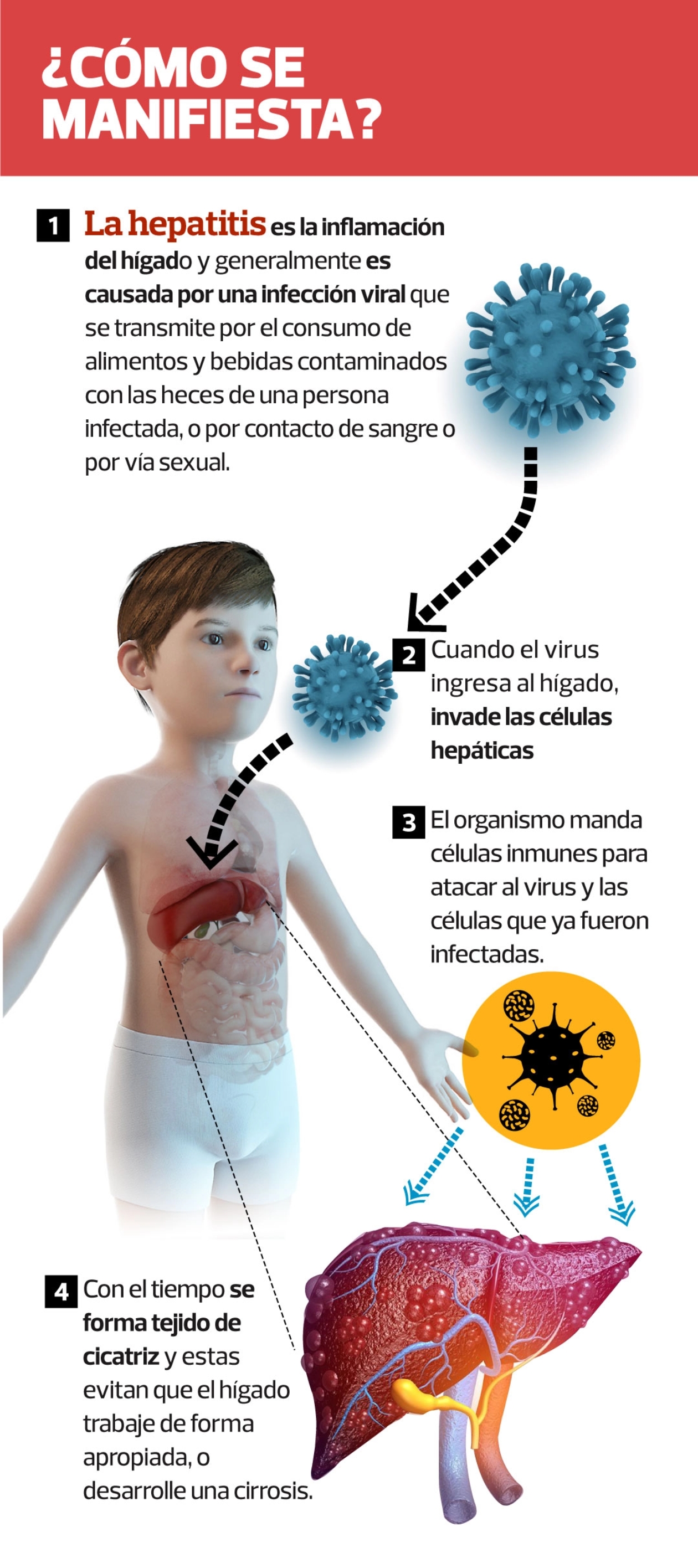 La peligrosa Todo lo que deben saber los padres sobre la nueva hepatitis aguda infantil 