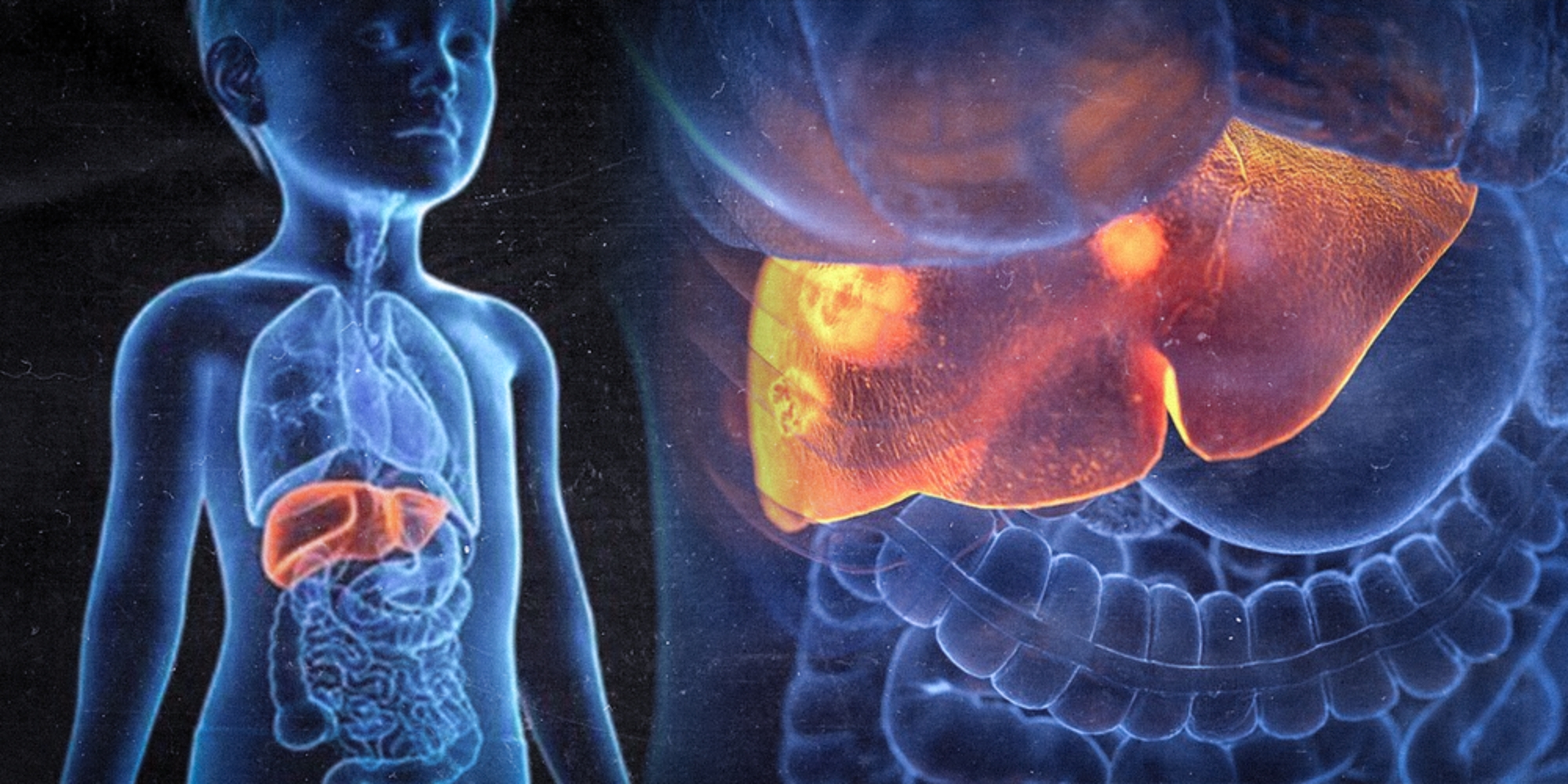 La peligrosa Todo lo que deben saber los padres sobre la nueva hepatitis aguda infantil 